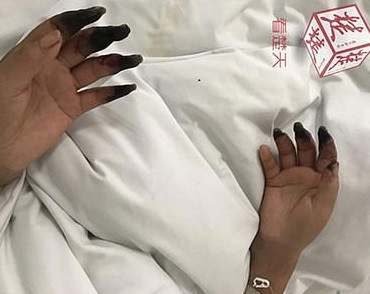 Opt dintre degetele de la mână au început să se înnegrească dintr-o dată. Boala de care suferă