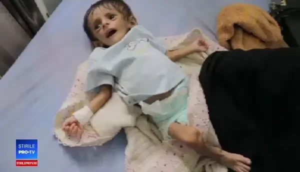 Copii subnutriți în Yemen