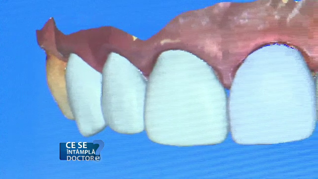 Problemele grave pe care le ascunde sângerarea gingivală. Sunt recomandate controale