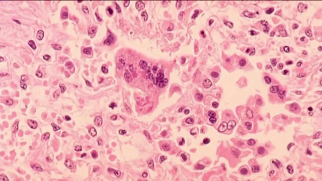 Stare de urgență în SUA din cauza pojarului. Ce amenzi riscă cei care nu se vaccinează