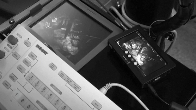 O nouă șansă la viață pentru un tânăr din Barcelona. A primit o inimă din plastic