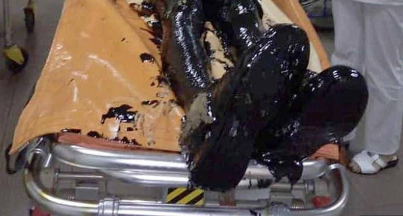 Pățania unui bărbat care a căzut într-o groapă imensă, plină cu smoală. Cum arată acum. FOTO