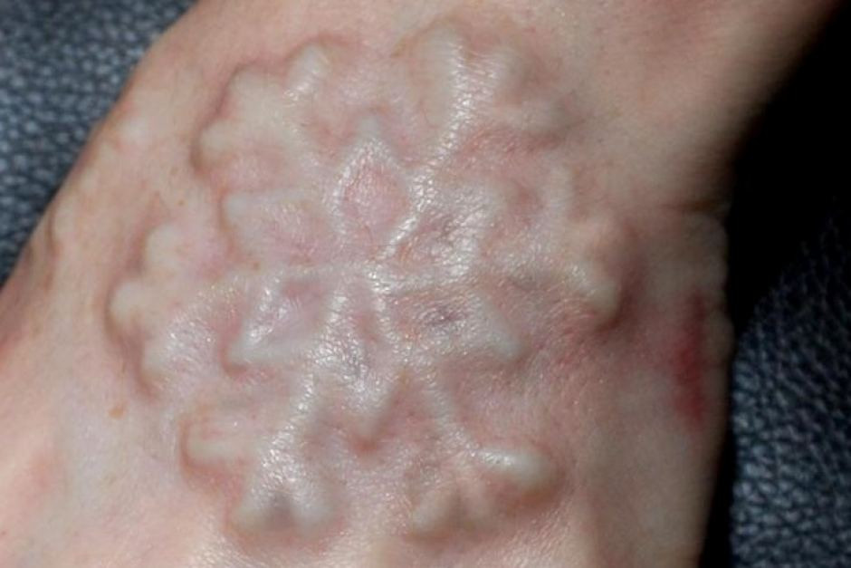 O femeie a murit după ce i s-au implantat 2 fulgi de plastic în mână. Cine a operat-o