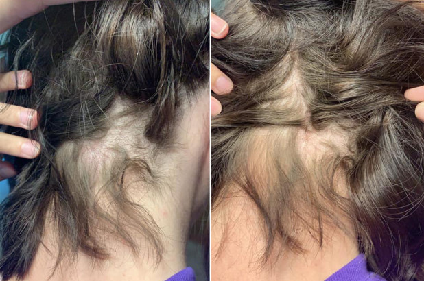 O femeie a rămas fără păr după ce a folosit un balsam. A depus plângere