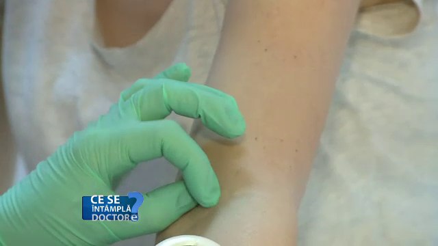 De ce este recomandat să mergem la medic dacă avem alunițe pe suprafața pielii