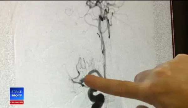 Patru români mor în fiecare oră din cauza unui AVC. Primele simptome alarmante