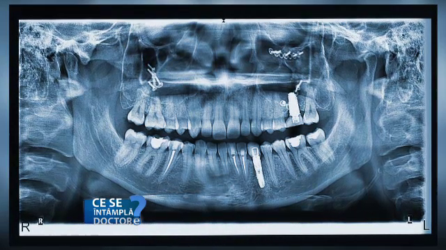 Cum ne afectează pierderea dinților sinusurile. Sfaturile medicilor