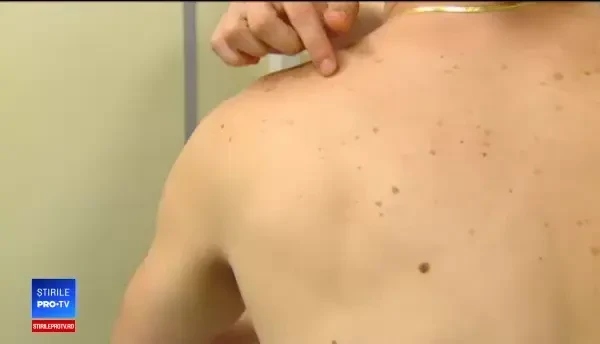 Tot mai mulți tineri din România, diagnosticați cu melanom. Cine sunt cei mai expuşi