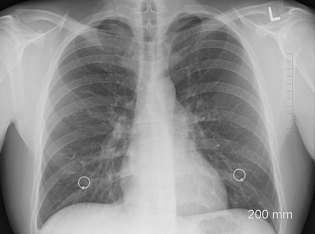 Cum ne afectează poluarea. Două gaze se intersectează în nasul și plămânii noștri