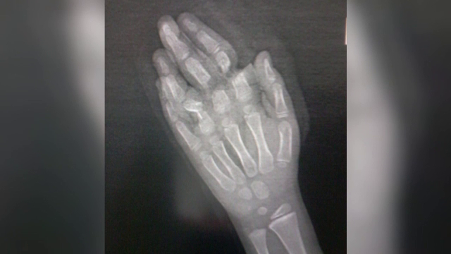 Un copil de 7 ani a ajuns la spital cu degetele amputate într-un accident casnic