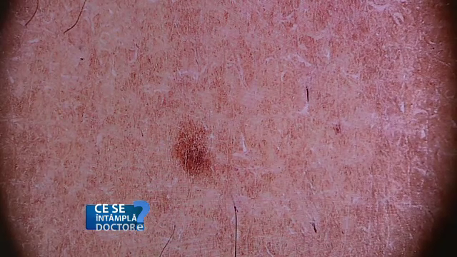 Cum arată cel mai periculos cancer de piele. Semnul pe care majoritatea persoanelor îl au