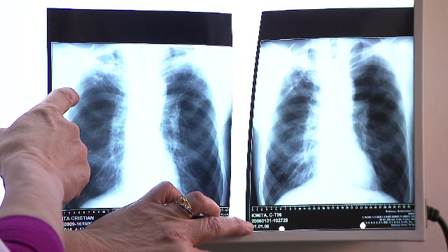 Care este cauza principală a deceselor provocate de bolile infecţioase. Directorul general al OMS: „Este revoltător”