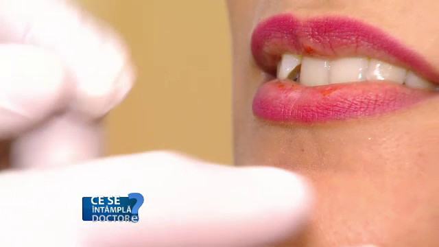 Buzele pot oferi primul semnal al unei boli grave. Când trebuie să mergi la medic