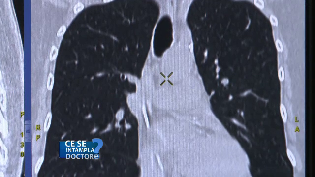 Boala gravă care se transmite ușor în mijloacele de transport în comun. Care sunt simptomele