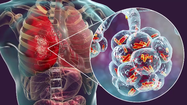 Epidemie de gripă în România. 52 de persoane au murit