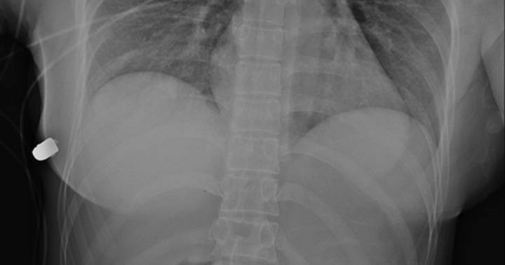 O femeie din Canada a supraviețuit unei împușcături, graţie unui implant mamar