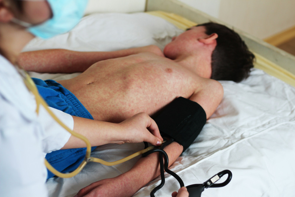 Epidemia de rujeolă din România ”s-a rezolvat”, dar nu prin vaccinare. Zeci de copii au murit