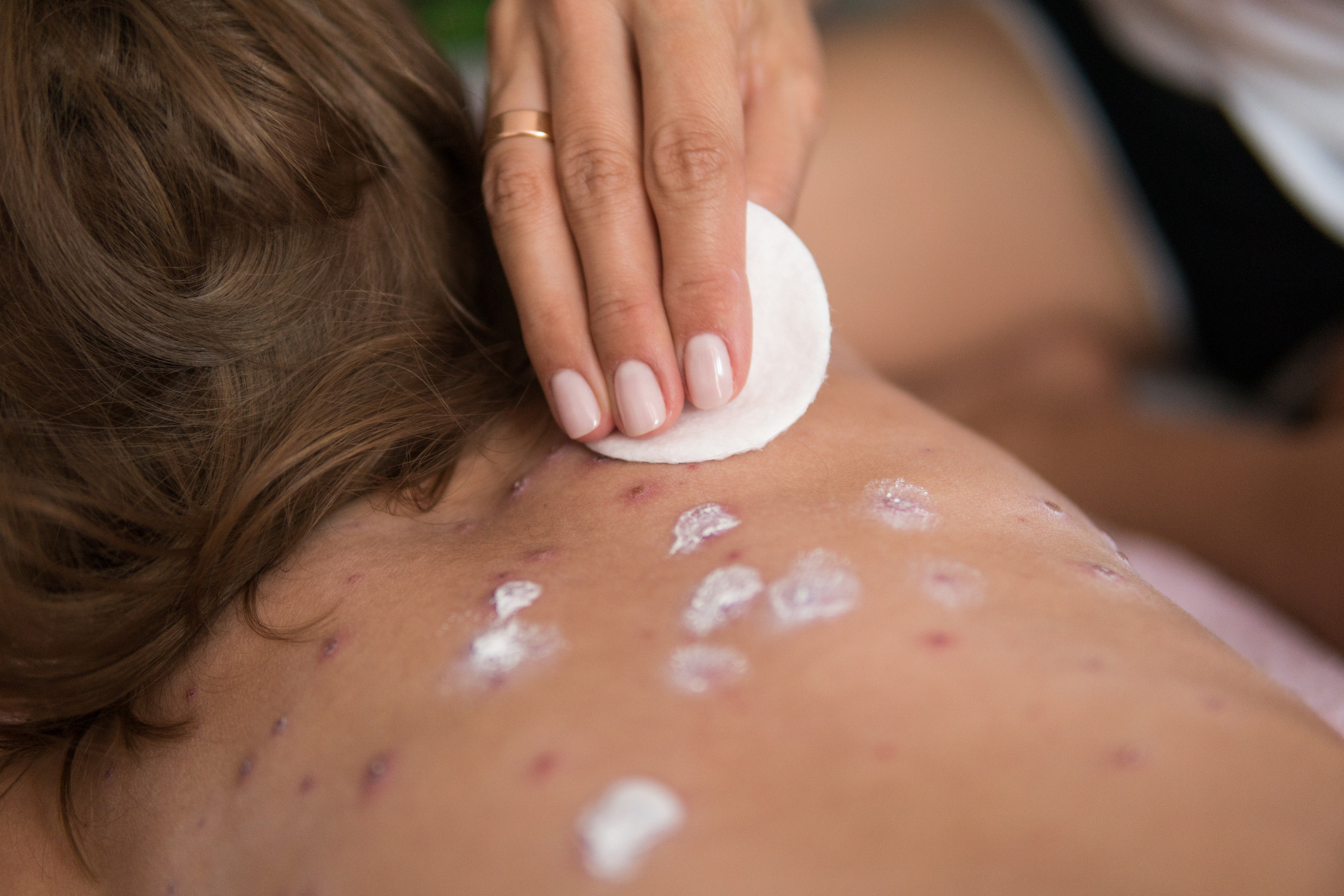 Rujeola face noi victime în Texas. Un al doilea copil nevaccinat a murit în aproape două luni. Epidemia se răspândește în SUA