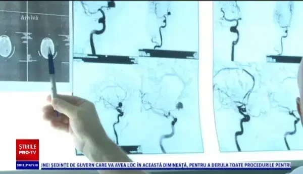 Specialiști: Riscul accidentului vascular cerebral crește substantial la pacienții infectați cu Covid-19