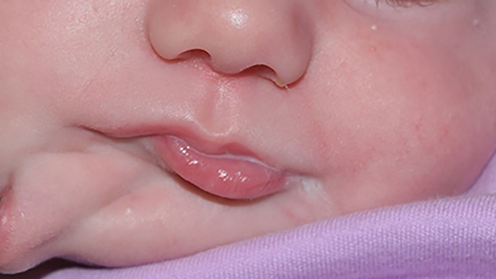 O fetiță din SUA s-a născut cu două guri. Cum arată după intervenția medicilor