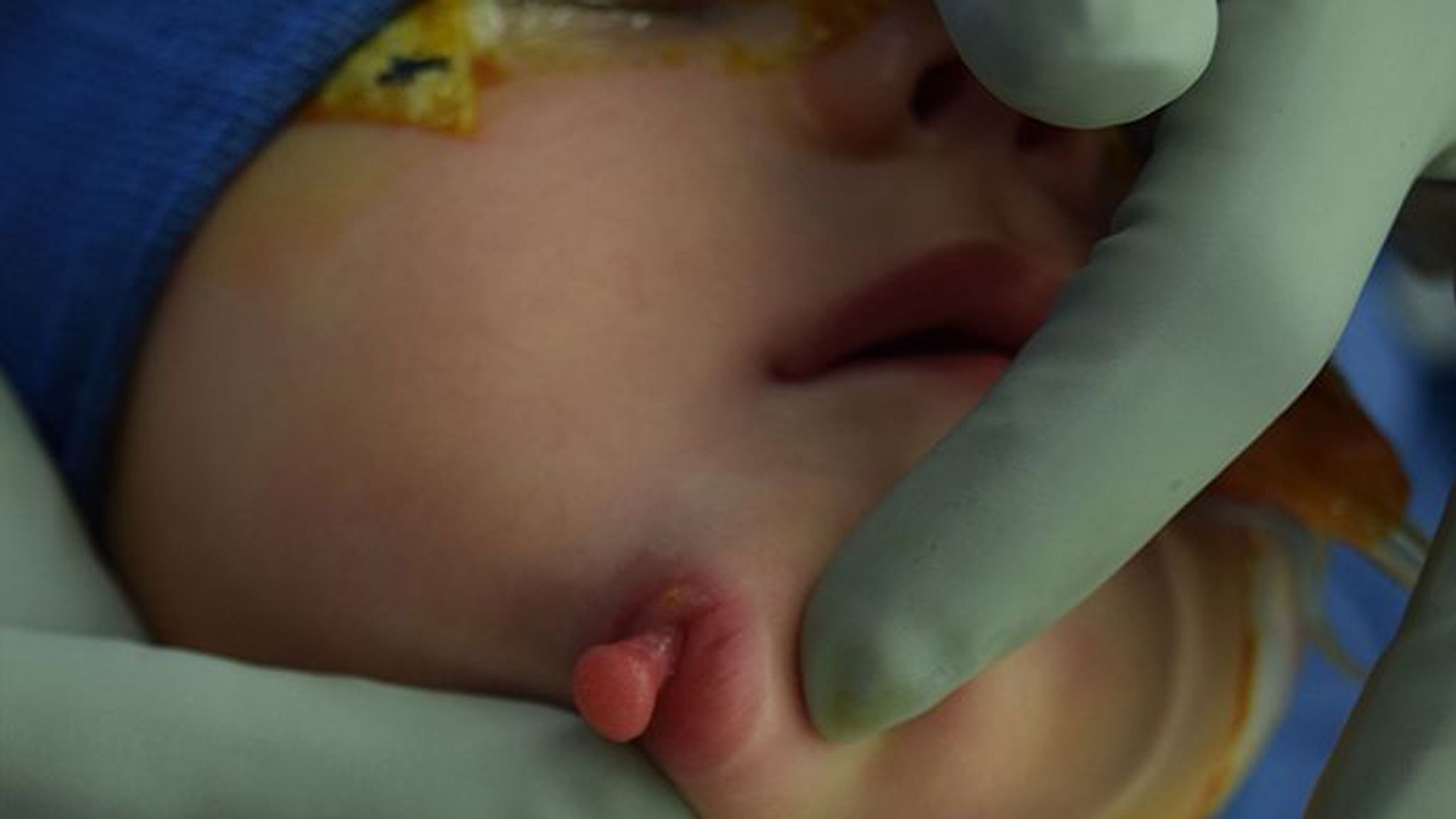 bebeluș cu două guri sua