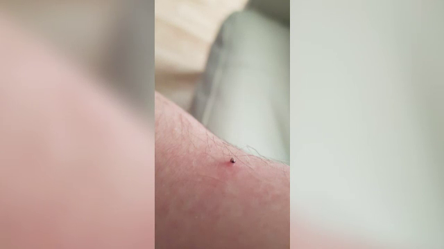 Se înmulțesc cazurile de înțepături de căpușe: ”Sunt peste tot”. Cum ne putem proteja