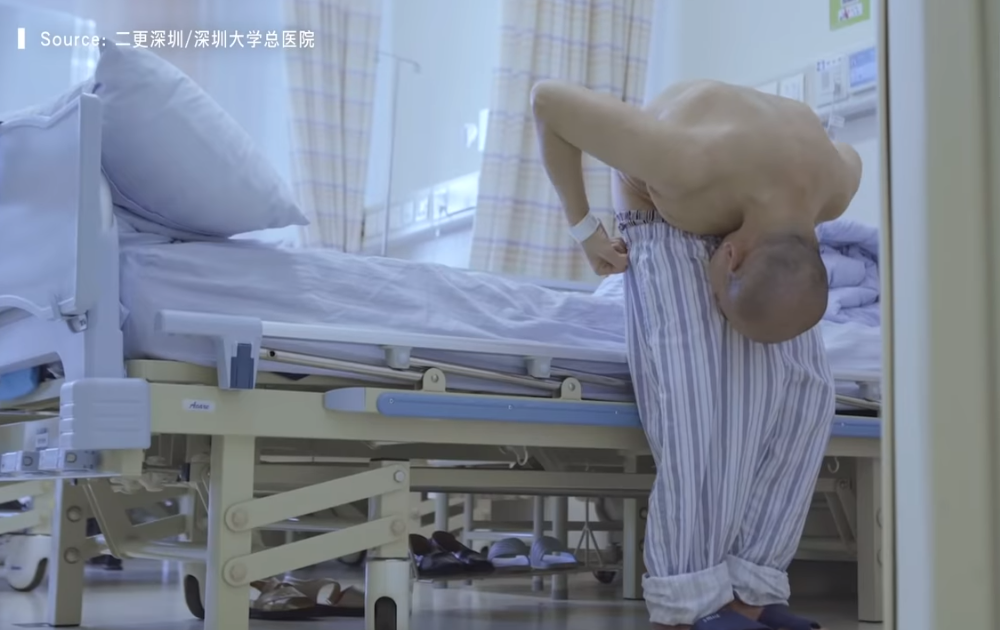 A stat îndoit 28 de ani din cauza spondilitei. Cum arată după ce medicii au reușit să-i îndrepte coloana