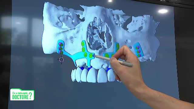 Pe măsură ce trece timpul, oasele îşi pierd din volum. Cum evoluează boala parodontală