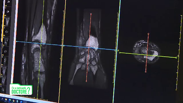 Cum recunoaștem că o persoană a făcut un accident vascular cerebral. Sfatul specialiștilor