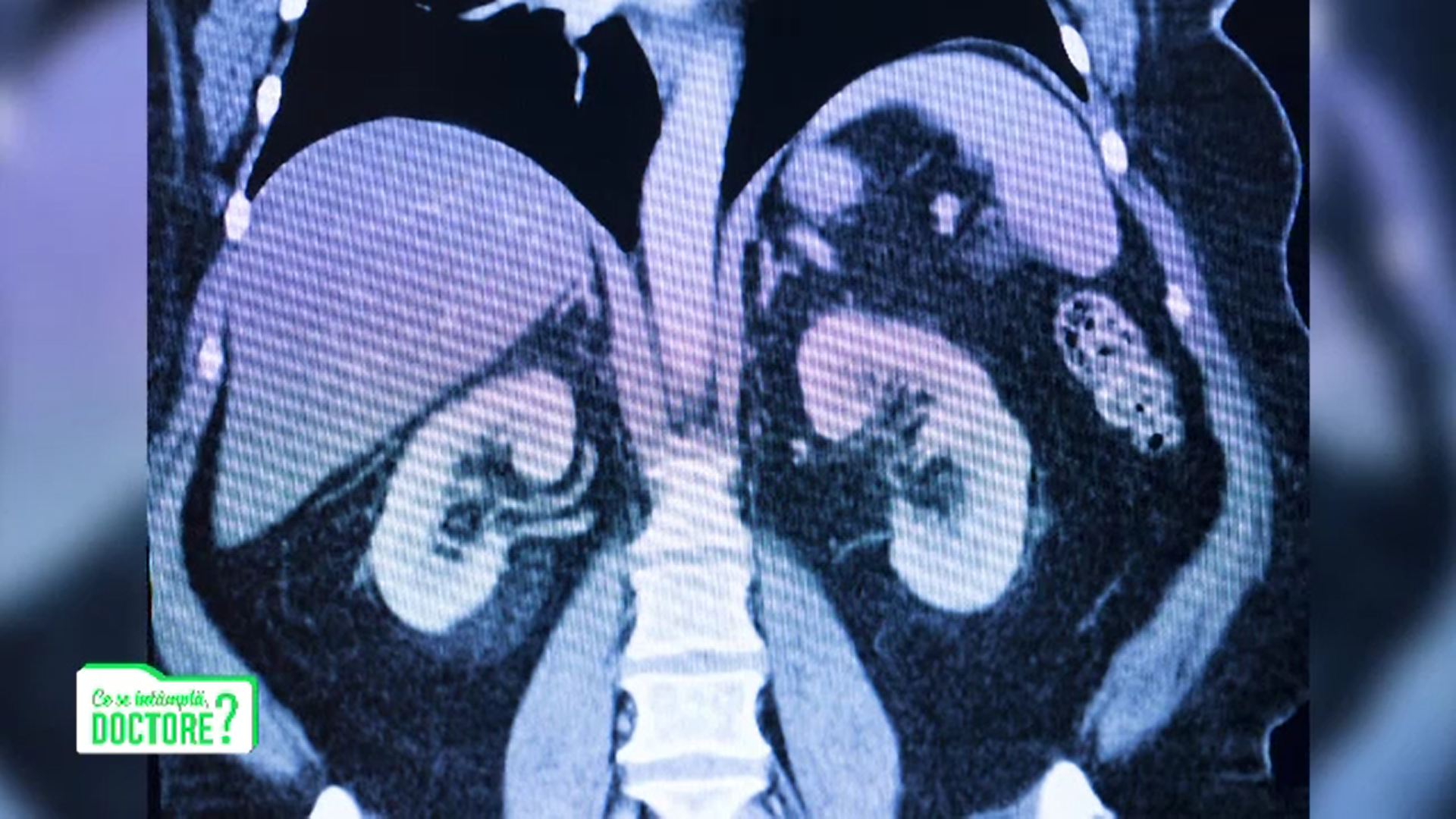 Poluarea are impact direct şi sever asupra rinichilor. Care sunt cele mai mari riscuri