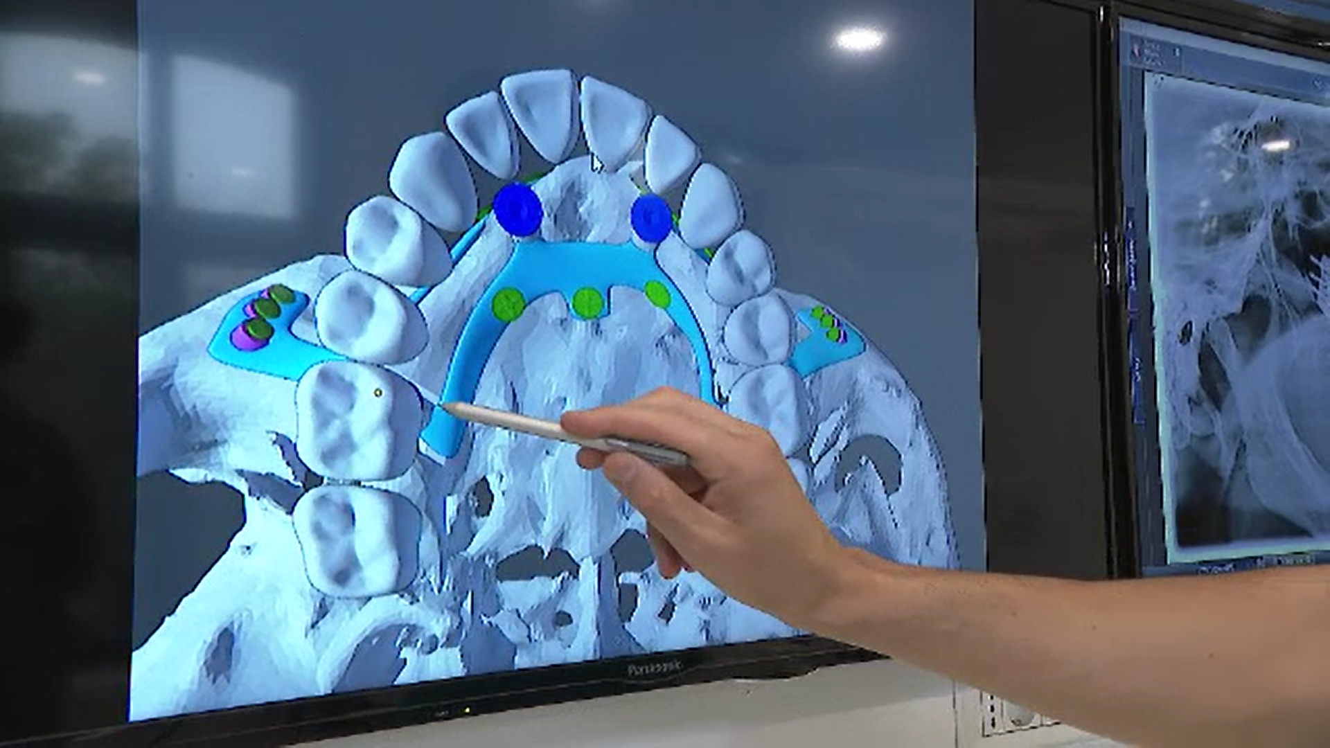 După o extracție dentară trebuie neapărat montată o coroană dentară. Explicația medicilor chirurgi