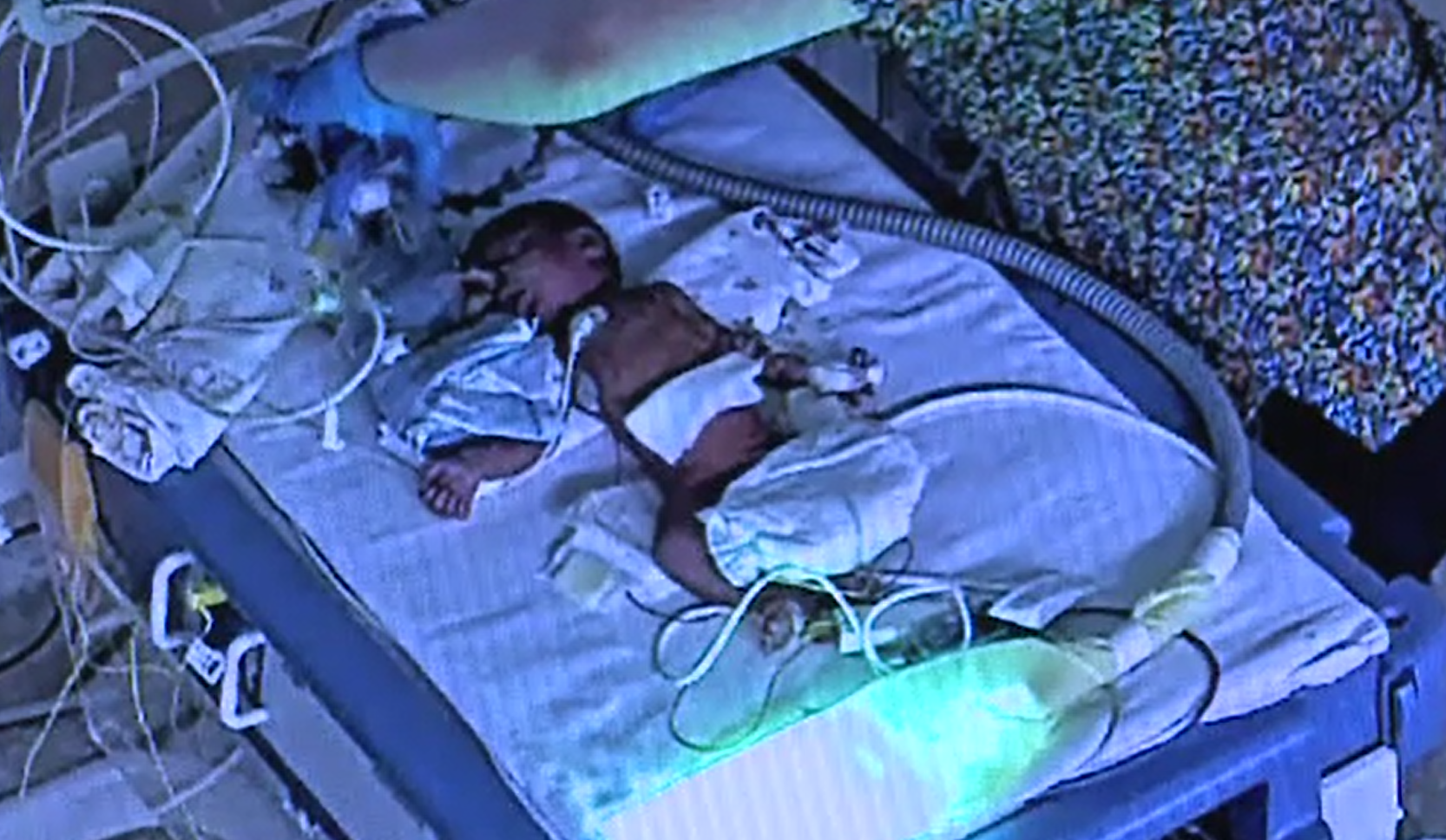 Șansă la viață pentru un nou-născut, abandonat într-o pungă în București. Medicii au reușit să îl salveze