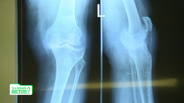 Dezaxarea membrelor duce la artroză. Ce metode de tratament există