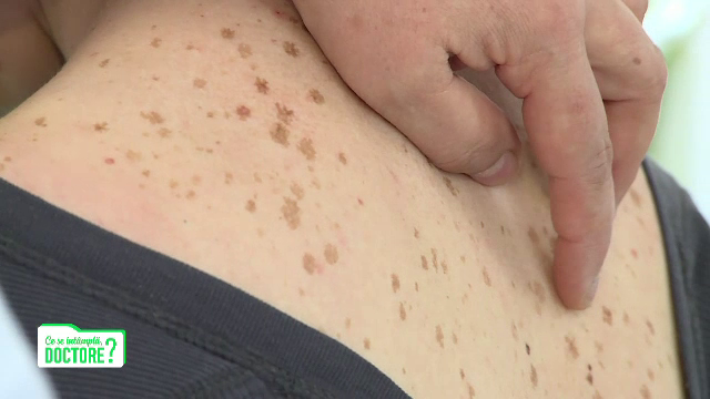 De ce sunt periculoase leziunile pe faţă, pe scalp sau pe urechi. Sfatul specialiștilor