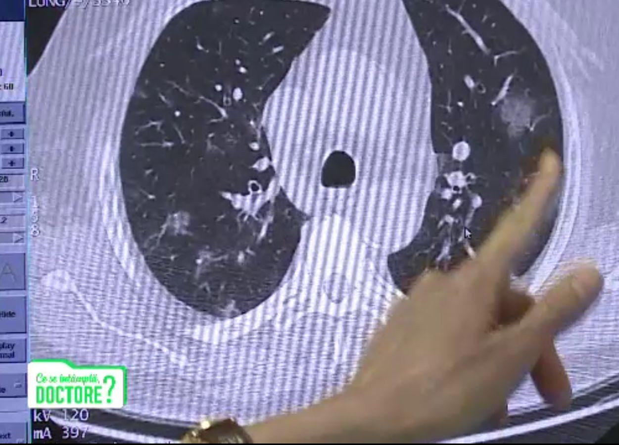 Ce trebuie să facă pacienții, după COVID, să nu rămână cu plămânii afectați. Sfatul medicilor