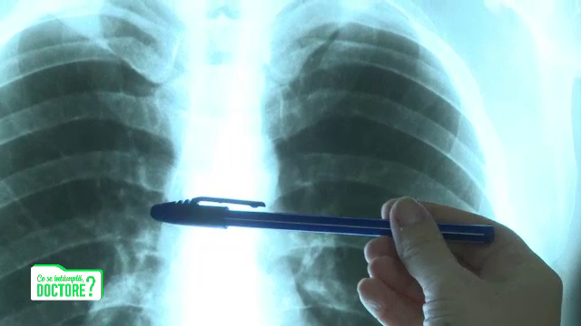 Ce sunt, de fapt, nodulii care pot apărea în plămâni. În 80% din cazuri nu sunt canceroși