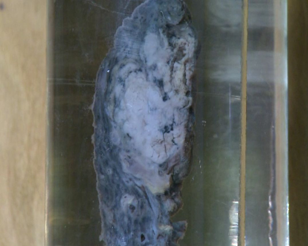 Pacienți cu COVID, descoperiți cu noduli pulmonari preexistenți. Pandemia a dus la o campanie nebănuită de screening