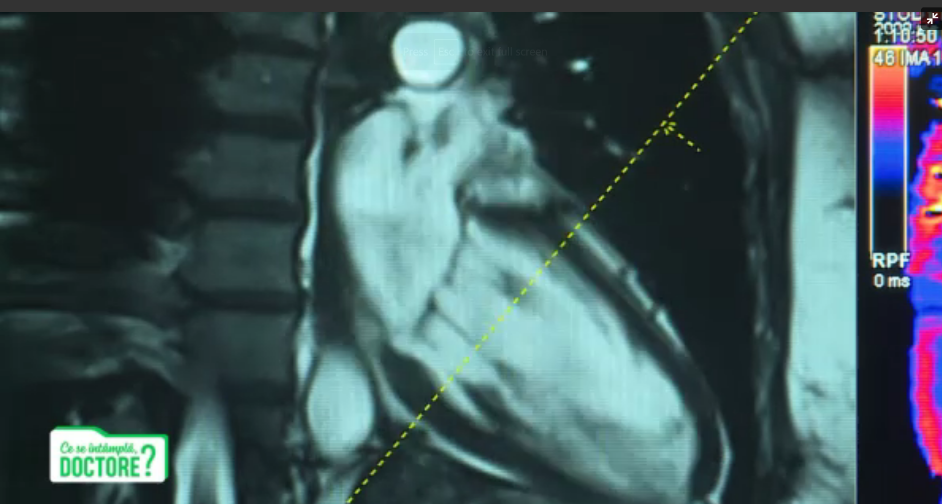 CSID. De ce este recomandată o consultație la medicul cardiolog după infectarea cu Covid-19