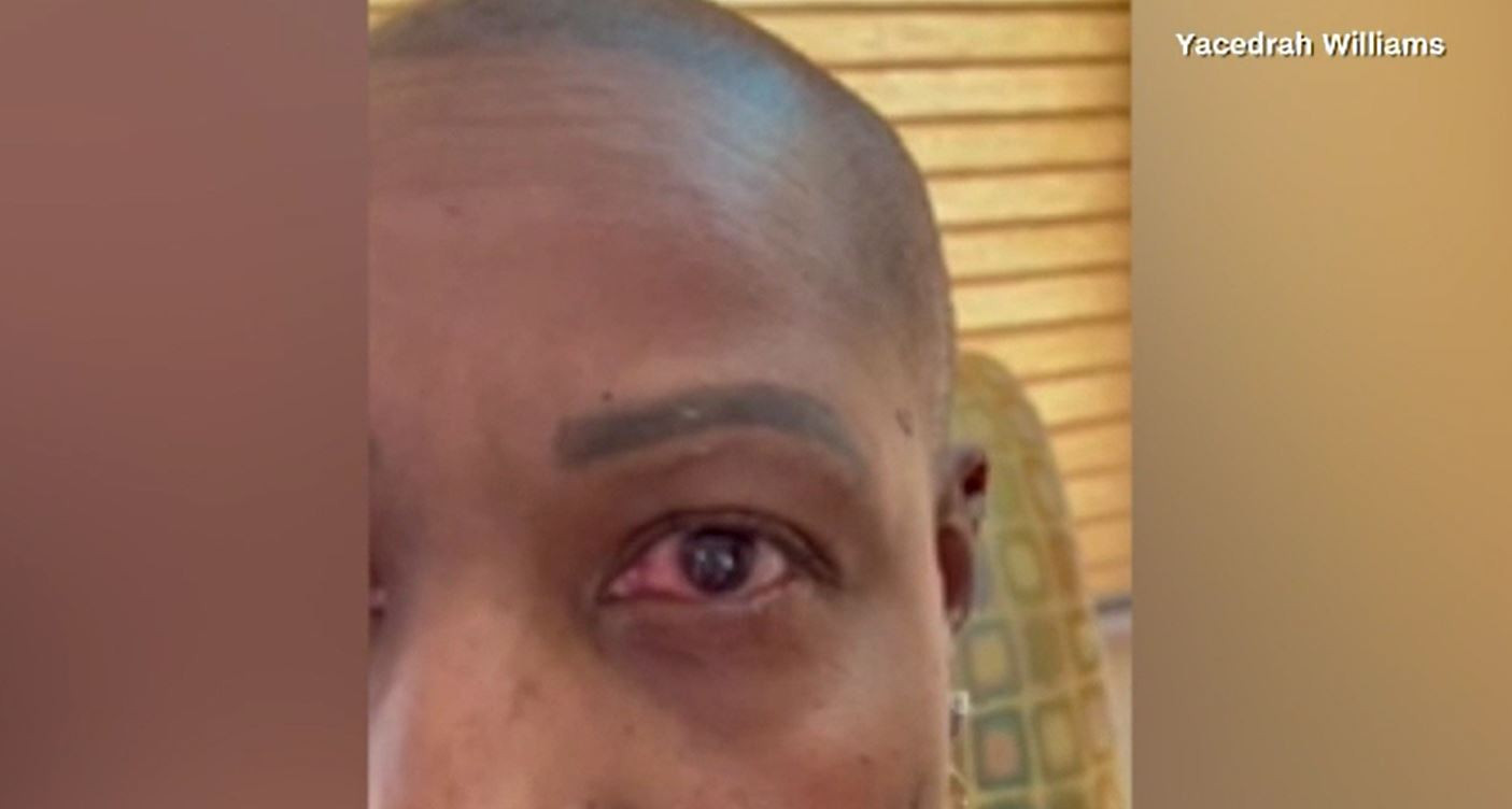 Și-a turnat lipici în ochi, în loc de picături. Cum a scăpat însă de o nenorocire