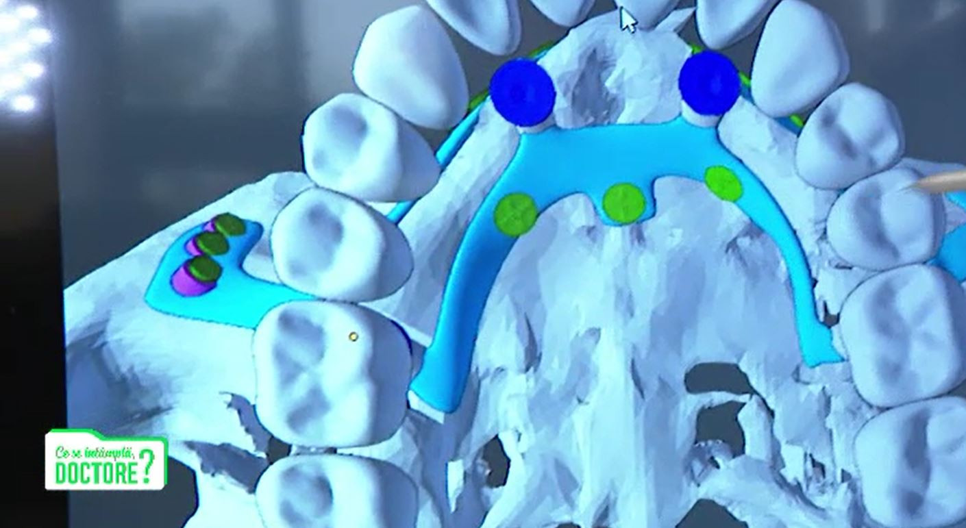 CSID. Cum pot fi scăpați de chinuri pacienții care și-au pierdut mai mulți dinți