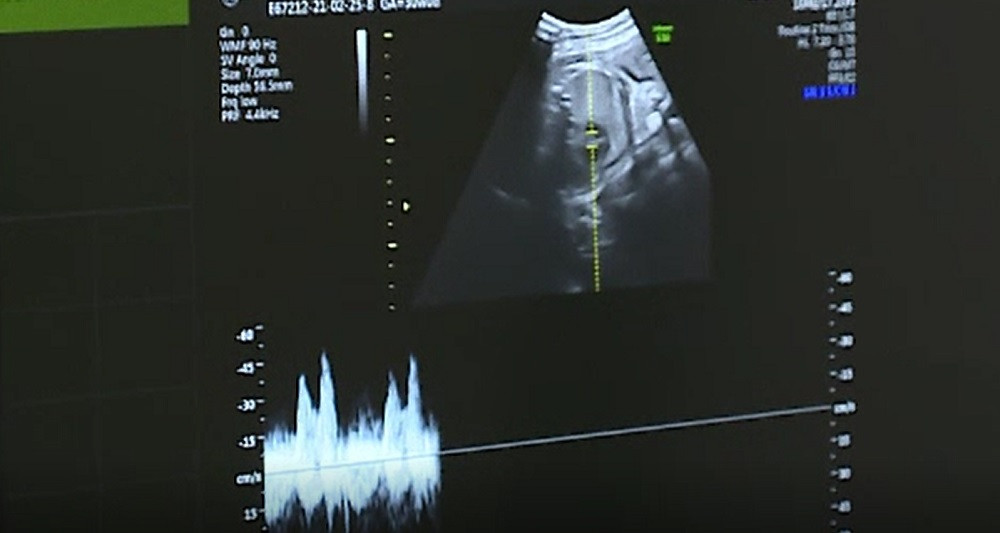 Două minore din Galaţi, de 13 și 14 ani, au devenit mame. Una dintre ele are şi COVID