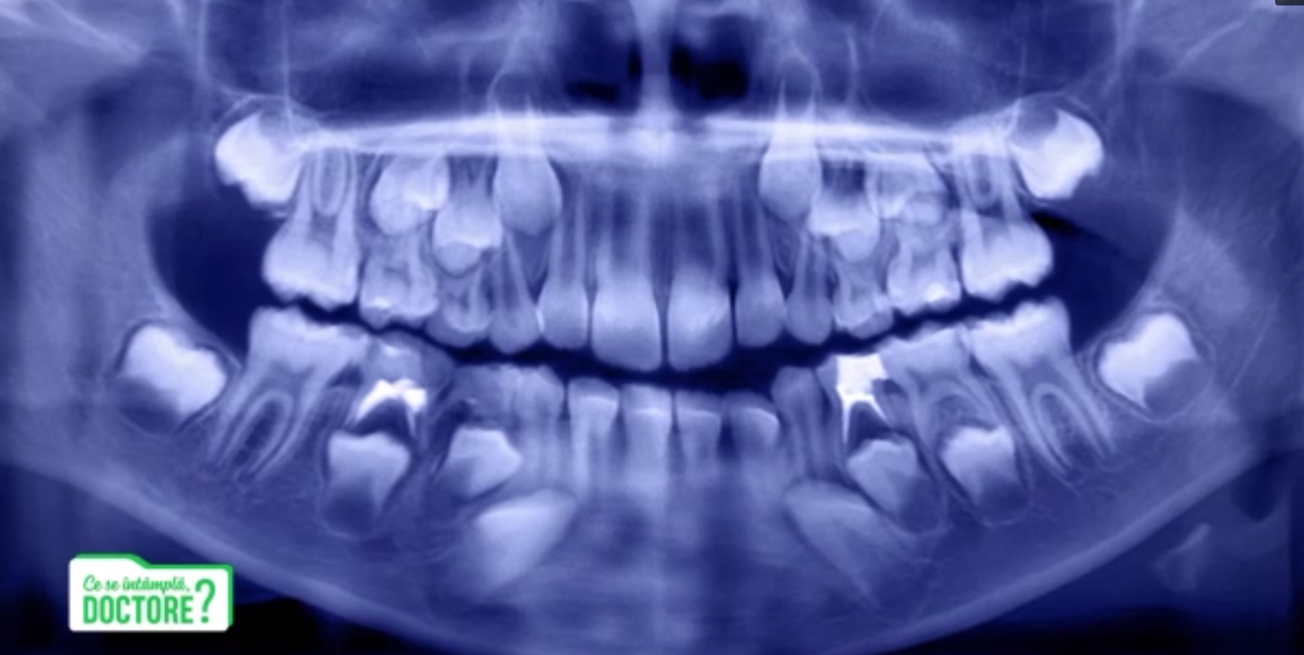 CSID. Care este cel mai eficient tratament pentru cariile apărute la dinții de lapte