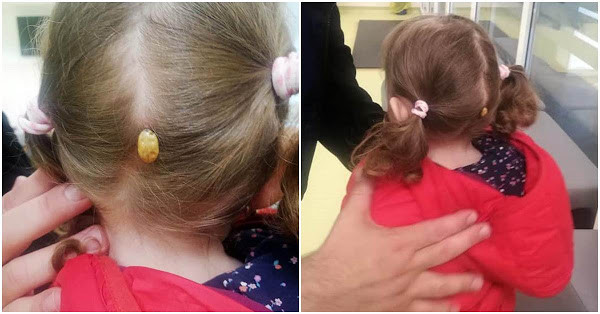 Ce i-a apărut unei fetițe în spatele capului, după ce s-a jucat într-un parc din Suceava