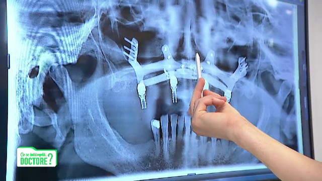 Care este cea mai bună opțiune pentru persoanele care își pierd dinții. Sfatul medicilor