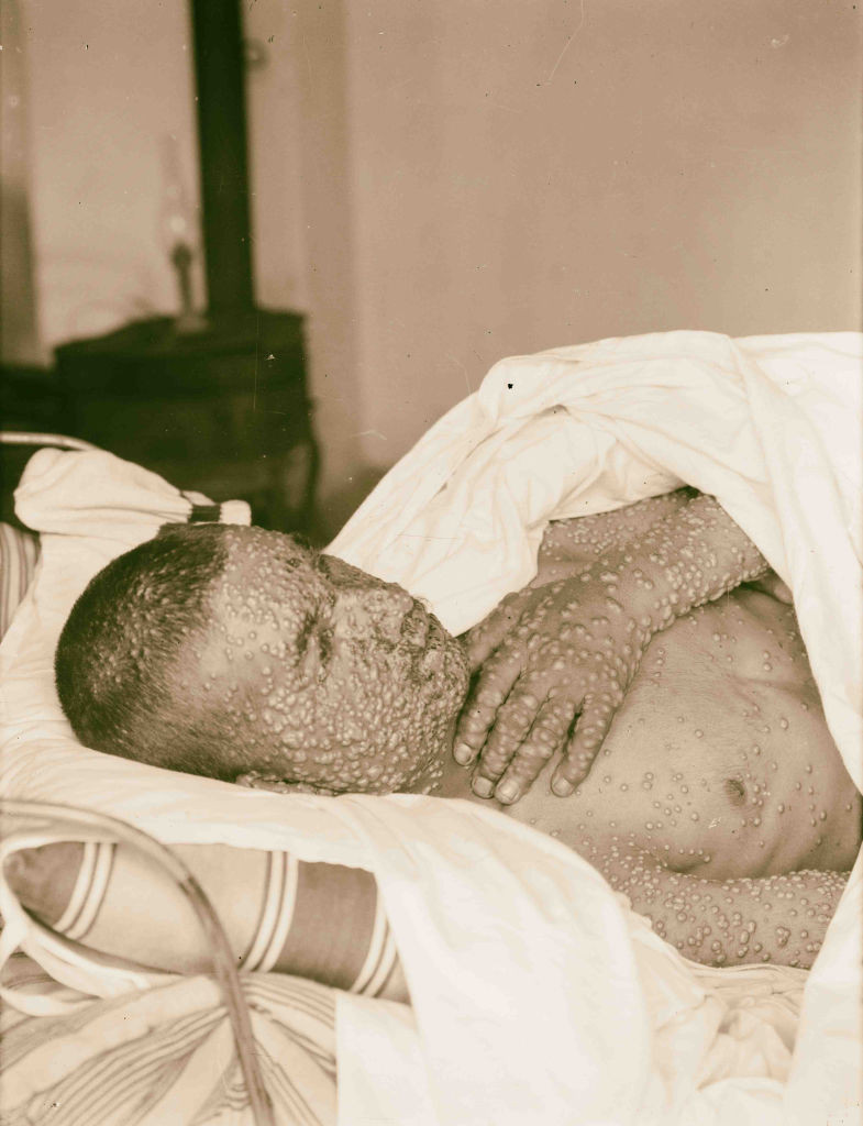 Eradicarea variolei ar fi fost imposibilă cu dezinformarea actuală, afirmă Anthony Fauci