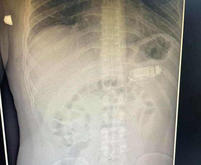 Un deținut s-a plâns de dureri de stomac mai multe zile. Ce i-au găsit medicii în stomac