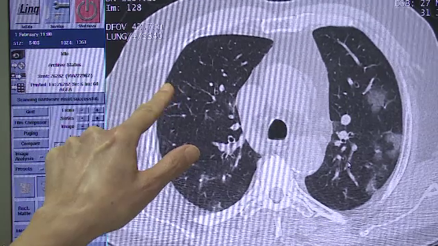 Ce este adenocarcinomul pulmonar. Investigația anuală care poate depista cancerul la plămâni într-o fază incipientă