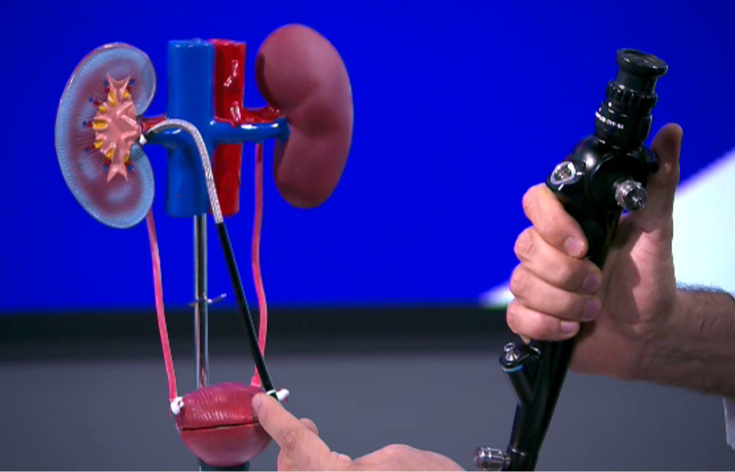 Una din zece persoane face pietre la rinichi. Cum se pot elimina prin metode neinvazive