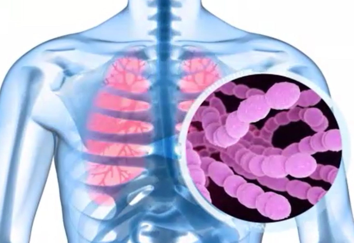 Vaccinarea anti-pneumococică și rolul ei esențial în lupta cu boala COVID-19