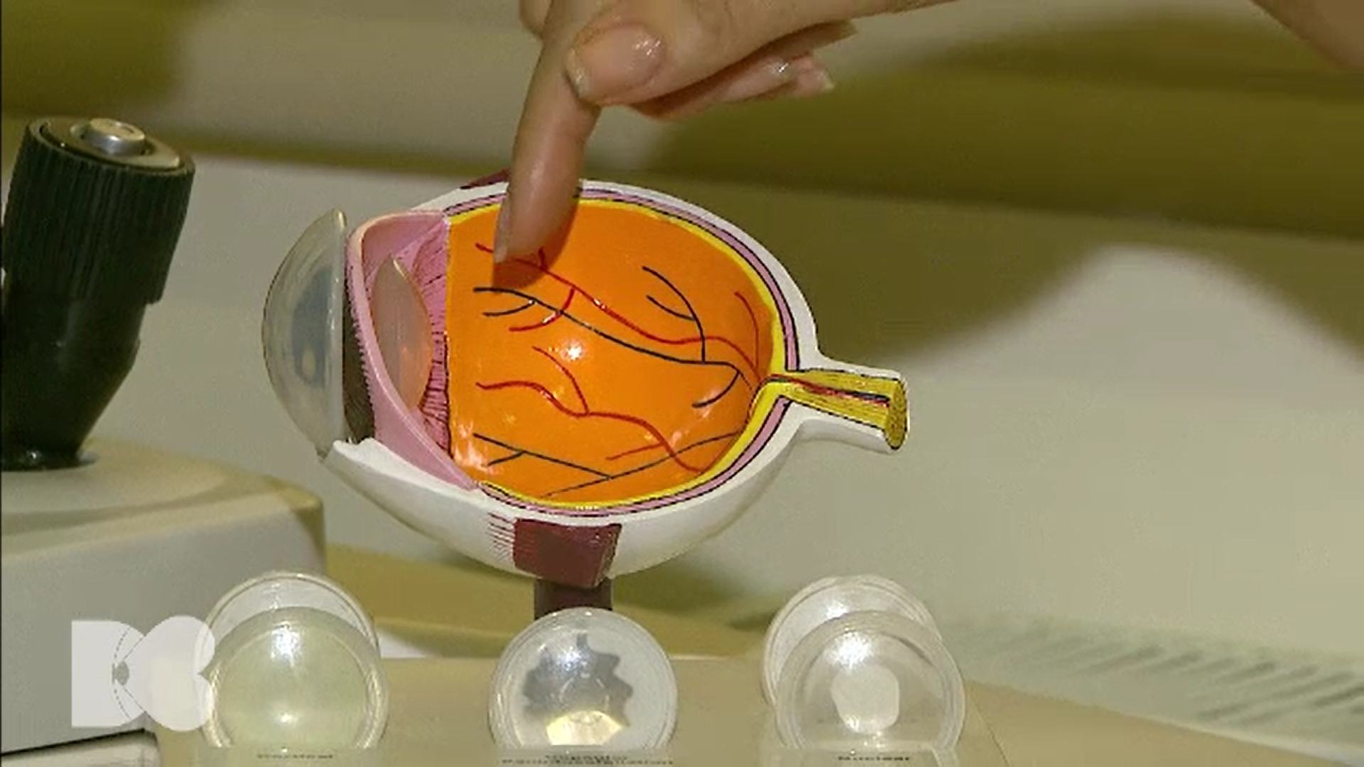 În diabet, nu suferă doar vasele inimii, ci şi vasele din retină. Medicii recomandă un control o dată pe an la oftalmolog